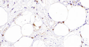 Positive immunostaining for MDM2.