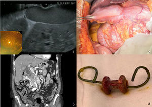 a) EUS image from procedure; b) CT for re-staging after neoadjuvant therapy, where the EUS-CD device is observed; c) intraoperative image of the cholecystoduodenal communication; d) Hot-Axios® device with pigtail.