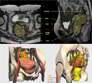 Magnetic resonance images (coronal and sagittal sections) showing a tumour corresponding to a second pelvic recurrence of a rectal neoplasm with involvement of neighboring pelvic structures, including the vaginal vault, bladder, bowel loops, and left levator ani muscle. Below, a three-dimensional anatomical reconstruction (Cella Medical Solutions® proprietary software) allows precise spatial visualisation of tumour extension and its relationship to organs and vascular structures, facilitating surgical planning in complex cases of pelvic exenteration.