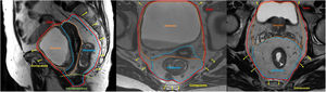 Images A and B: Sagittal and coronal sections of a pelvic MRI of a patient, illustrating the different types of pelvic exenteration according to the structures included in the resection. Image C: Coronal section of a male patient. The orange perimeter delineates an anterior exenteration, which includes the bladder and, in women, the internal genital organs. The blue perimeter corresponds to a posterior exenteration, which affects the rectum (and also the genital organs in women). The red perimeter represents a total pelvic exenteration, which includes resection of the bladder, rectum, and genital organs. The yellow lines indicate additional structures that may be included in a compound exenteration, such as the levator muscles or bony structures. Finally, the green line indicates the plane of the levator muscles, serving as a reference for classifying the exenteration as supralevator or infralevator, depending on whether these muscles are spared.