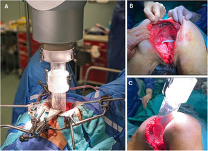 Intraoperative radiotherapy (IORT) in patients undergoing pelvic exenteration. There are three types of IORT: intraoperative electron beam radiotherapy (IOERT) like imaging, high-dose-rate intraoperative brachytherapy (HDR-IORT), and low-kilovoltage IORT. IOERT has faster treatment times, simpler preparation, and greater tissue penetration. HDR-IORT, with more flexible applicators that better adapt to the pelvis, delivers more concentrated doses, but the treatment time is longer. Kilovoltage IORT has less penetration, requires less shielding, but its applicator is fixed and the treatment time is slower.80 (A) Case 1: IORT administration via laparotomy. (B and C) Case 2: patient in the prone position, with IORT directed toward the lateral wall of the pelvis.