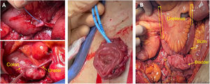 Urinary reconstructions. Image A: construction of an inverted wet colostomy. Image B: reconstruction using ileal loop interposition (bilateral ureter-ileum-bladder anastomosis).