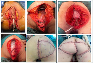 Perineal reconstructive techniques after pelvic exenteration. In both cases, Permacol® biological mesh is used, secured with interrupted, non-absorbable monofilament sutures in a crown-shaped pattern. Skin and subcutaneous tissue closure is performed by the Plastic Surgery team using a V-Y advancement flap (case A) and a double V-Y flap (case B).