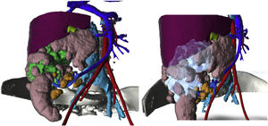 3D reconstruction of right adenocarcinoma.