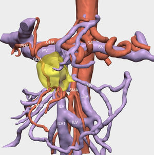 Preoperative 3D study. https://www.cellams.com. Occlusion of the splenoportomesenteric axis and abutment of the superior mesenteric artery by the tumour can be seen. SMA, superior mesenteric artery; CHA, common hepatic artery; HAP, hepatic artery proper; GDA, gastroduodenal artery; SA, splenic artery; PV, portal vein; SV, splenic vein; ILV, ileal vein; ILV1, ileal tributary vein 1; ILV2, ileal tributary vein 2; JJV jejunal vein; IMV, inferior mesenteric vein; MSC, mesocolon. The pancreatic tumour is indicated in yellow. (For interpretation of the references to colour in this figure legend, the reader is referred to the web version of this article).
