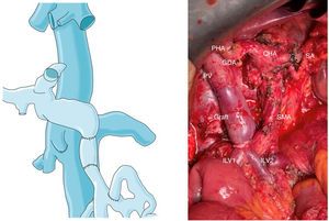Diagram of the venous configuration after venous shunt closure and completion of venous reconstruction, and intraoperative photograph after venous shunt closure and completion of venous reconstruction. The venous graft was adapted to the length of the portal vein to avoid kinking. SMA, superior mesenteric artery; CHA, common hepatic artery; PHA, hepatic artery proper; GDA, gastroduodenal artery; SA, splenic artery; PV, portal vein; SV, splenic vein; ILV, ileal vein; ILV1, ileal vein 1; ILV2, ileal vein 2.