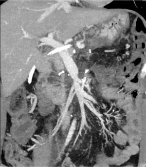 Postoperative MDCT study, sagittal imaging. Final portal mesenteric venous reconstruction is evident.