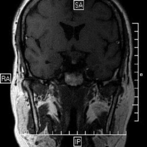 Thick-section initial magnetic resonance imaging of the skull suggesting pituitary macroadenoma.