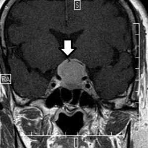 Thin-section magnetic resonance imaging centered on the pituitary gland showing the dural tail characteristic of meningioma.
