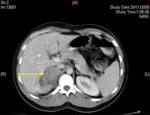 CT image showing a low attenuation oval solid mass in the right adrenal gland.