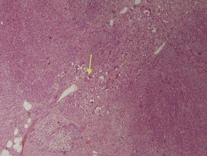 Mature ganglion cells forming small groups and nests (arrow) with neuromatous stroma, growing on normal adrenal tissue.