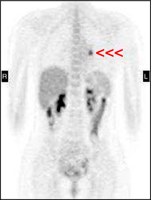 Coronal plane of 18FDG-PET showing hyperuptake by a small pathological focus, 1.5cm in size, in the left hilar region (arrow) with physiological tracing throughout the rest of the body.