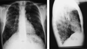 Posteroanterior chest X-rays taken in 1988.