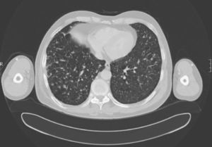 CT scan of the chest.