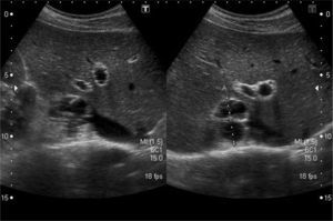Thick-walled cystic mass in the right adrenal gland.