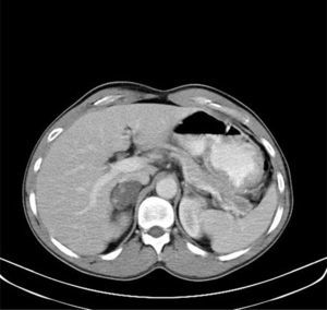 High-density cystic mass with wall thickenings showing an increased uptake in the right adrenal gland.