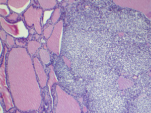 Thyroid follicles surrounded by tumor cells.