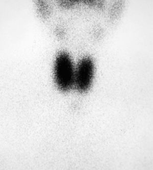 Tc-99 scintigraphy showing diffuse hyper-uptake.