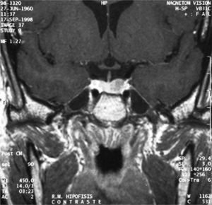 Pituitary MRI showing a 1.2-cm left pituitary adenoma.