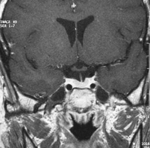 Postoperative MRI with no evidence of recurrence.