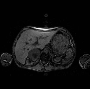 Heterogeneous lesion with necrotic center in the right adrenal gland.