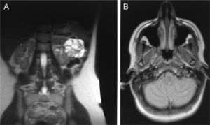 (A) Axial abdominal MRI. Heterogeneous cystic tumor, 7.6×6.2 in diameter, in the left kidney. (B) Brain MRI. High uptake lesions in the left cerebellar hemisphere, a 5-mm lesion and a more peripheral 3-mm lesion, corresponding to small cerebellar hemangioblastomas.