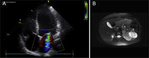 (A) Transthoracic echocardiography (apical plane 4C). Mitral regurgitation. (B) Abdominal MRI cross-section. Clearly outlined left adrenal mass, 2.3cm in diameter, suggesting pheochromocytoma (marked with red arrow). (For interpretation of the references to color in this figure legend, the reader is referred to the web version of the article.)