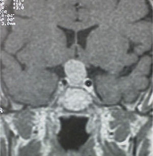 MRI of the head showing the sellar mass studied.
