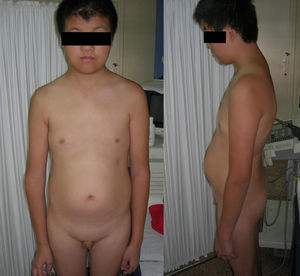 Physical characteristics of an adolescent with polysomy 48,XXXY.