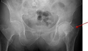 Displaced femoral neck fracture.
