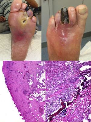 Upper images: top left, plantar view of foot showing an ulcer on the head of the 3rd metatarsal, with marked perilesional reddening and a necrotic 3rd toe. Ulcer was exposed after delamination of the surrounding hyperkeratosis, which is typical in neuropathic lesions. Top right, dorsal view of foot showing reddening of midfoot and 3rd toe necrosis. Lower images: bottom left, blood vessel congestion and dilation, as well as granulation tissue. Ulceration and a necrotic appearance of epidermis and dermis are also seen. Bottom right, intensive, predominantly eosinophilic inflammatory infiltrate with eosinophils involving bone tissue.