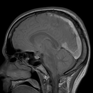 MRI of the brain showing signal hyperintensity of the superior longitudinal sinus, the straight sinus, and the proximal portion of the transverse sinuses.