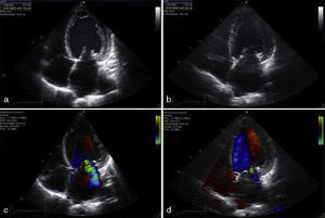 Apical four-chamber echocardiographic view showing the left ventricle with increased end-diastolic volume (a) that normalized 8 months after pituitary apoplexy (b), showing an improved ejection fraction. Note the decrease in severity of mitral regurgitation, shown before (c) and after pituitary apoplexy (d).