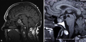 T1-weighted pituitary MRI showing an intrasellar mass with hemorrhagic contents (a). Tumor size decrease at 6 months of follow-up (b).
