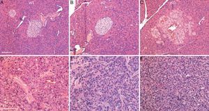 Histology of pancreas and pancreatic tumors. (A–C) Islet histology of wild type (WT) and heterozygous (HZ) mice at 18months, and Gcgr−/− mice (KO) at 15months. Sections were stained with hematoxylin and eosin. (D–F) Histology of each of the gross lesions shown in Fig. 3D–F, respectively. Note the typical trabecular pattern of neuroendocrine tumor cells. Bar, 100μm.