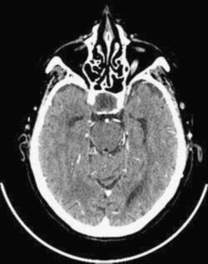 Pituitary macroadenoma extending to chiasmatic cisterns, with no evidence of bleeding inside the tumor.