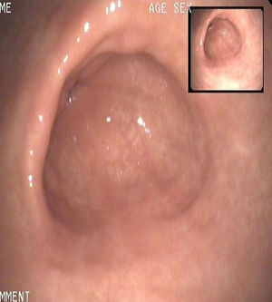 Normal mucosa after treatment.