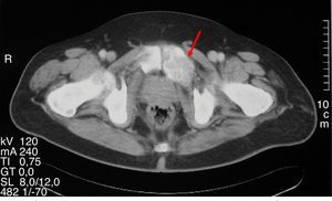 Expansive lytic lesion corresponding to osteitis fibrosa cystica in a pelvic CT scan.