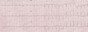 Twelve-lead electrocardiogram showing sinus tachycardia with poor R wave progression in right precordial leads and non-specific repolarization changes in V5 and V6.