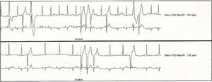Twenty-four hour ambulatory Holter monitoring showing sinus rhythm with maximum heart rate of 158bpm and minimum nighttime HR of 60bpm, with a mean HR of 102bpm, and monomorphic ventricular extrasystole of moderate severity with doublets and triplets.