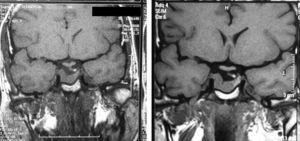 Pituitary MRI. T1-weighted coronal section without contrast showing stability of pituitary adenomas before (A) and after (B) pregnancy.
