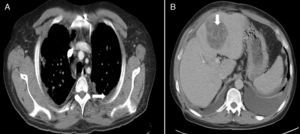 Images from the baseline computed tomography of the chest and abdomen: (A) Left pleural effusion (arrow), nodular pulmonary lesions. (B) Liver abscess in left hepatic lobe, segment 3 (arrow).