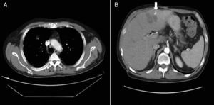 Images from computed tomography of the chest and abdomen after abscess drainage and antibiotic therapy: (A) Improvement of pulmonary nodules and absence of pleural effusion. (B) Significant abscess reduction (arrow).