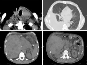 CT of the neck, chest, and abdomen without intravenous contrast. Local recurrence, lung micrometastases, right pleural effusion, multiple liver metastases, and retroperitoneal adenopathic mass.