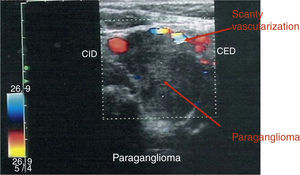 Color Doppler imaging control after 7 months of treatment with lanreotide 120mg/28 days showed a right PGL of maximum diameter 29mm that included both the internal and external carotids, as well as an important decrease of the vascularity.