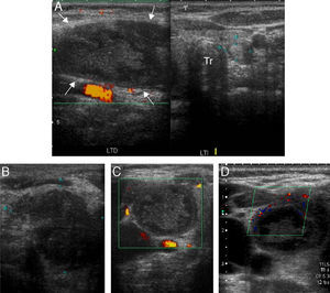 Neck ultrasound: (A) panoramic study of the thyroid gland, with image summation, showing gland enlargement at the expense of the right thyroid lobe (RTL), which has an altered echostructure with a hypoechoic nodular lesion which appears to infiltrate the cervical muscle planes (white arrows). An isoechoic nodule is also seen in the left thyroid lobe (LTL). Tr: trachea. (B–D) B-mode, power Doppler, and color Doppler. Detail of hypoechoic mass, approximately 50mm×37mm in size, with no internal vascularization but discrete peripheral vascularization.