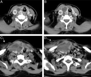 Axial CT images following intravenous administration of iodinated contrast. (A and B) Occupation of right cervical space by mass with cystic density and ill-defined contours, intimately related to the right thyroid lobe (*), and showing heterogeneous uptake of contrast medium, with peripheral enhancement. (C and D) Rarefaction of fat in cervical planes with extension of the process to the right pectoral region, where thickening of the greater pectoral muscle is seen (arrows). This mass displaces the trachea to the left, and right supra-aortic trunks posteriorly (c: right carotid artery; Tr: trachea; vy: right jugular vein).