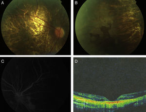 (A) Eye fundus photograph showing a pale optic disk, retinal vessels with mild tortuosity, and retinochoroidal dystrophy characterized by diffuse atrophy of the retinal pigment epithelium and visualization of choroidal vessels. (B) Eye fundus photograph showing pigment deposition toward the periphery. (C) Fluorescein angiography showing a preserved vascular tree and hyperfluorescent areas of dye accumulation. (D) Optical coherence tomography showing retinal thinning with changes in the outer retinal layers.