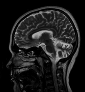 Magnetic resonance imaging of the brain with gadolinium contrast showing increased cerebellar width and depth consistent with cerebellar atrophy.
