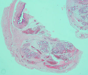 Testicular biopsy showing images (in black circles) which could correspond to müllerian remnants.